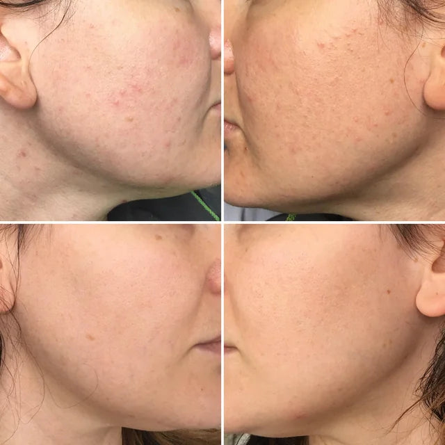 The Ordinary Glycolic Exfoliating Toner , Peeling Solution, Niacinamide