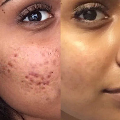 Fade Acne Scars Fast: The Ordinary’s Ultimate Scar-Removal Set for Clearer, Smoother Skin!