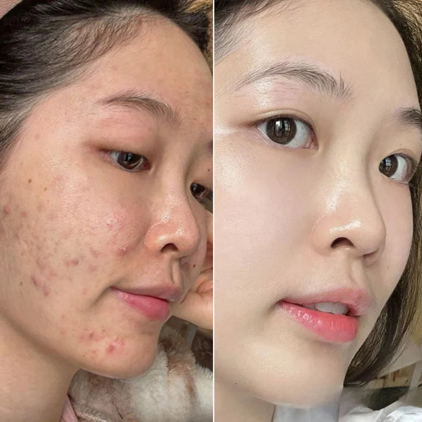 Fade Acne Scars Fast: The Ordinary’s Ultimate Scar-Removal Set for Clearer, Smoother Skin!