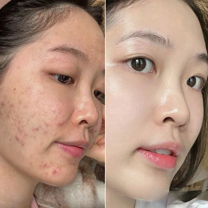 Fade Acne Scars Fast: The Ordinary’s Ultimate Scar-Removal Set for Clearer, Smoother Skin!