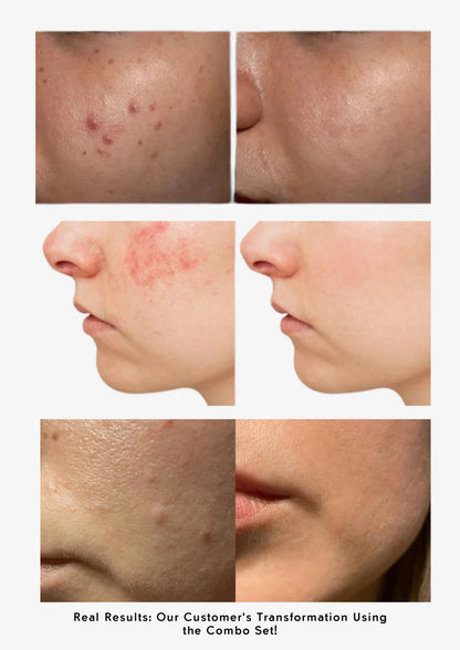 Fade Acne Scars Fast: The Ordinary’s Ultimate Scar-Removal Set for Clearer, Smoother Skin!